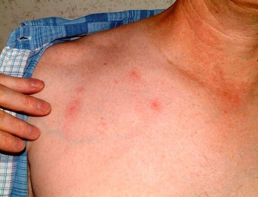 sintomas de parasitas sob a pele