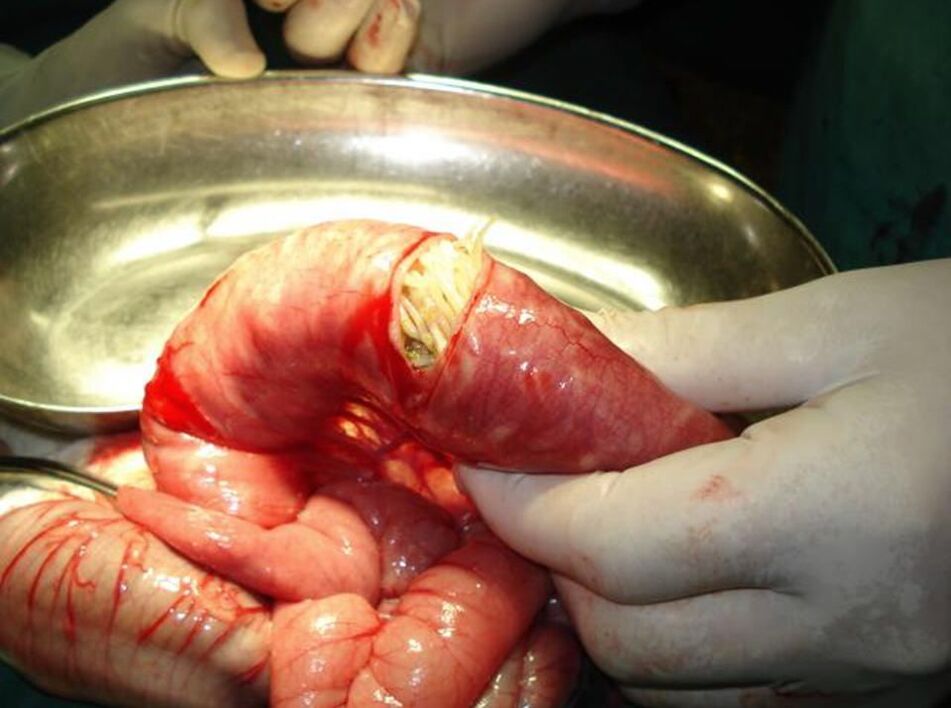 Lombrigas no intestino humano