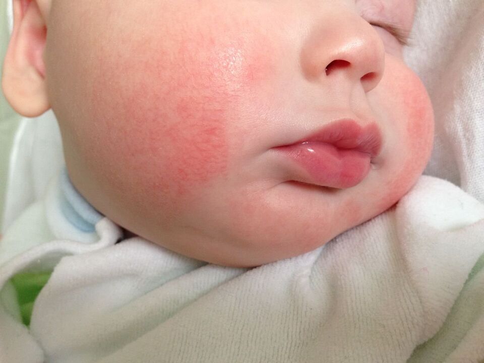 Um sinal de vermes em uma criança é urticária alérgica